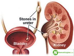 Chữa sỏi thận hiệu quả bằng quả chuối hột rừng